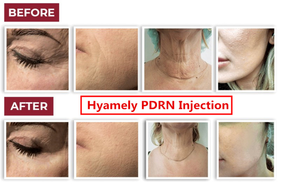 Boyun Beyazlatma Yüz Enjeksiyonu İçin Hyamely Cell Regation Skin Booster PDRN Serum