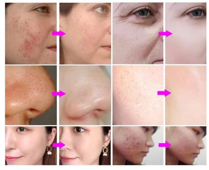 Yüz Makineleri Yüz Temizleme Makine Anti-Kırışık Su Oksijen Jetpeel 3