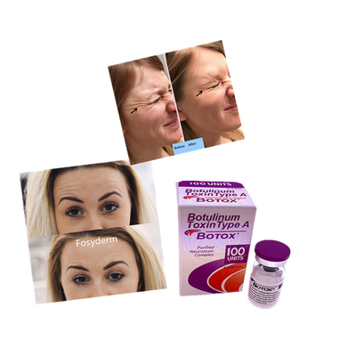 Dermal Dolgu Kırışıklık Karşıtı Allergan  100 Adet Botulinum Toz Enjeksiyonu