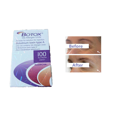Allergan  Enjeksiyonu Botulinum Toksin 100 Adet Alın Kırışıklıkları