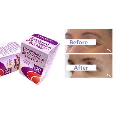 Kırışıklık Kaldırmak İçin Botulinum Toksin Allergan  Enjeksiyonu