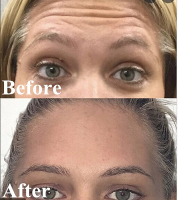 Korean Botulax  Botulinum Toxin 100 Adet Kırışıklık Giderici