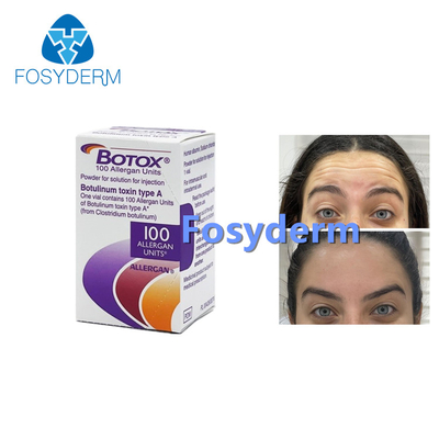 Yüz Kırışıklıklarını Kaldırmak İçin 100Units Allergan Botulinum Toxion Botox Tip A