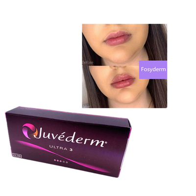 2 ml Juvederm Hyaluronic Acid Dermal Filler Rumple Filler Chin Lips Ultra 3