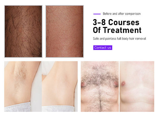 Güzellik Ekipmanları Fosyderm Lazer Epilasyon Makinesi 3 Dalga 12 Bar