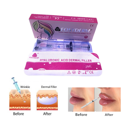 Fosyderm 2ml Hyaluronic Acid Gel Dermal Filler Enjeksiyonlar Yüz ve Burun Cilt Bakımı için