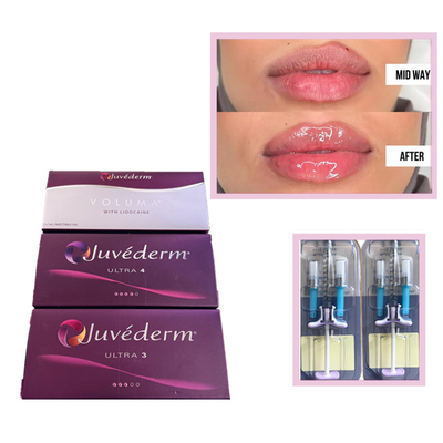 Juvederm Voluma Ultra3 Ultra4 HA Gel dolguları 2 ml Hyaluronik Asit