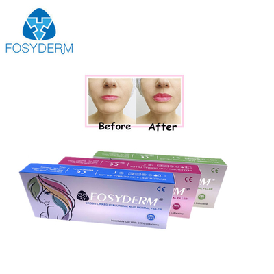 Gel 1 ml, kırışıklık azaltma ve yüz şekillendirme için hiyaluronik asit dolgu