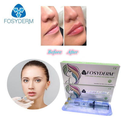 Gel 1 ml, kırışıklık azaltma ve yüz şekillendirme için hiyaluronik asit dolgu