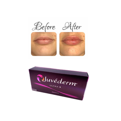 Juvederm Enjekte edilebilir Hyaluronik Asit Dermal Filler Gel