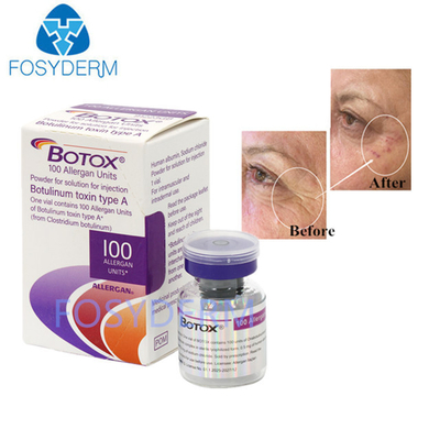 A Tip 100 Birim Allergan Botulinum Toksin Dermal Dolgu Hyaluronik Asit