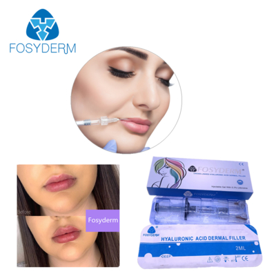 Yüz Dudak Yanak Çene için Hyaluronik Asit Dolgu 24mg/ml