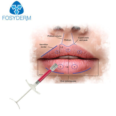 En Popüler 1ml Kırmızı Dudak Dolgu Hyaluronik Asit Enjekte Edilebilir Dermal Dolgu