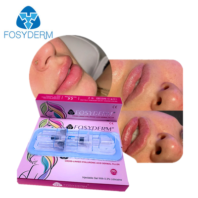 Yüz Gençleştirme HA Dermal Dolgu Maddesi Yüz Çene Yanak Dudak Vücut Canavar Kalça