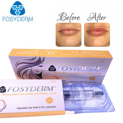 Hyaluronik Asit Dermal Dolgu Anti kırışıklık Yüz kaldırma 1ml 2ml