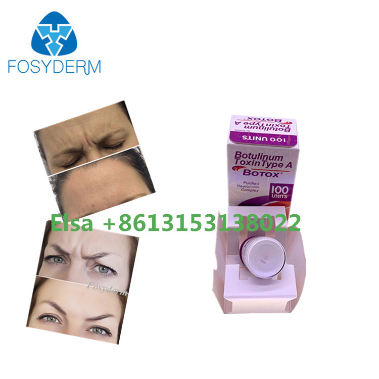 Botulinum Toksin Tip A Botoks Dermal Dolgu Kırışıklık Karşıtı Yüz Enjekte Edilebilir