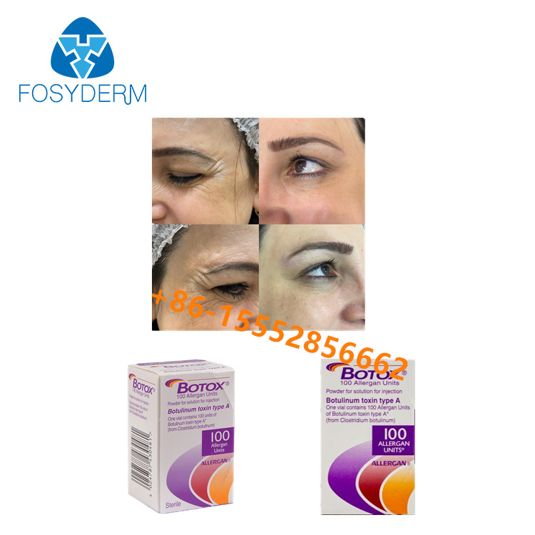Kırışıklıkları Kaldır Botulinum Toxin 100 Adet Allergan  Type A