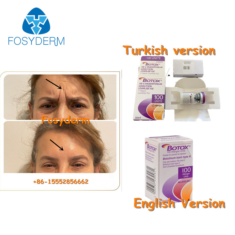 Yüz Kırışıklıklarını Kaldırmak İçin 100Units Allergan Botulinum Toxion  Tip A