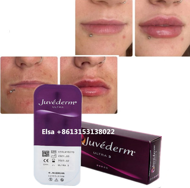 Kozmetik Deri Bakım Enjeksiyonlar Dudak Plumper Juvederm Doldurucu Enjeksiyon Burun Çene Dudak
