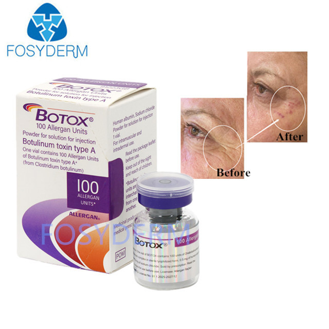 A Tip 100 Birim Allergan Botulinum Toksin Dermal Dolgu Hyaluronik Asit