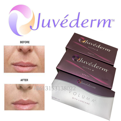 Juvederm Hyaluronik Asit Yüz Dolgusu Uzun Ömürlü Ultra3 Ultra4 Hacim Enjeksiyonu