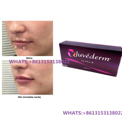 Dudaklar için Juvederm Dermal Filler Juvederm Ultra3 Ultra4 Fillers Ön Doldurulmuş Şırınga