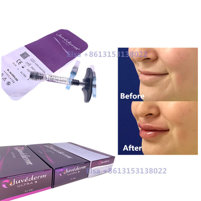 2×1 ml Enjekte edilebilir Dermal Dolgu Juvederm Şırınga Ultra3 Ultra4 Hacim