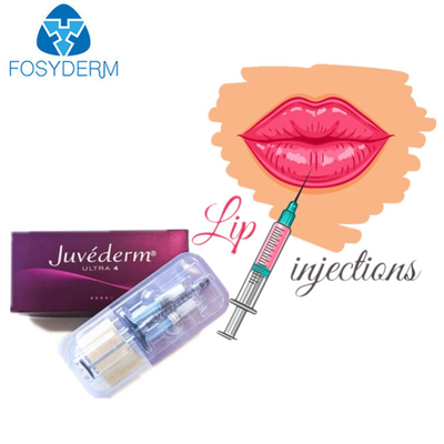 Yüz Dudakları İçin Juvederm Ultra 3 Hyaluronik Asit Dermal Dolgu