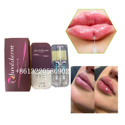 Ultra3 Juvederm Dudak Dolgu Enjeksiyonu 2ml Hyaluronik Asit Dermal