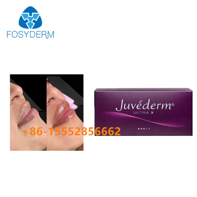 Dudak Geliştirme Dermal Dolgu Juvederm 2ml Hyaluronik Asit Enjeksiyonu