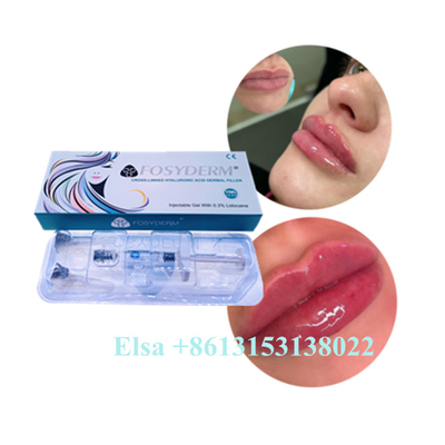Hyaluronik Asit Jel Enjeksiyonu Juvederm Dudak Dolgusu Ce Yaşlanma Karşıtı 1ml 2ml 5ml