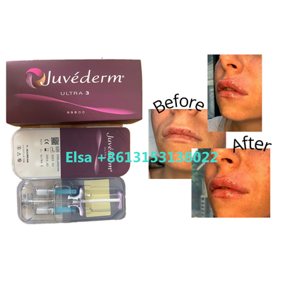 Kozmetik Ürünler Juvederm Yüz Dudakları İçin Dermal Dolgu
