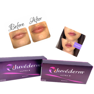 Hyaluronik Asit Dermal Jel Enjeksiyonu Juvederm Dudak Dolgusu Ce Yaşlanma Karşıtı 2ml