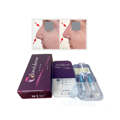 Yüz Dudak Çapraz Bağlı Dermal Dolgu Juvederm Ultra3 Hyaluronik Asit Jel