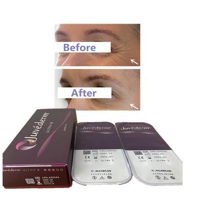 Juvederm 2ml Ultra3 Ultra4 Voluma Hyaluronik Asit Dermal Dolgu Dudak Dolgusu 24mg