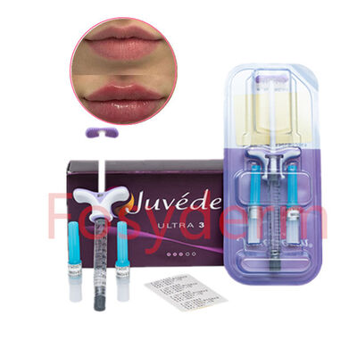 Juvederm Hyaluronic acid dermal filler Ultra3 Lips Lifting