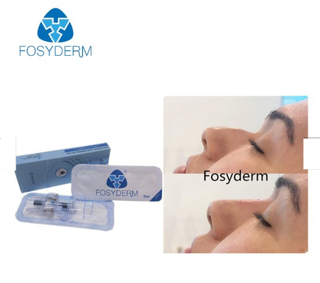 Fosyderm Çapraz Bağlantılı Derin Çizgi Dolgu 2ml Burun Yukarı için Dermal dolgu