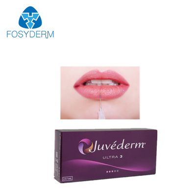 Dudak Juvederm Ultra 3 Hyaluronik Asit Dermal Filler 2 * 1ml