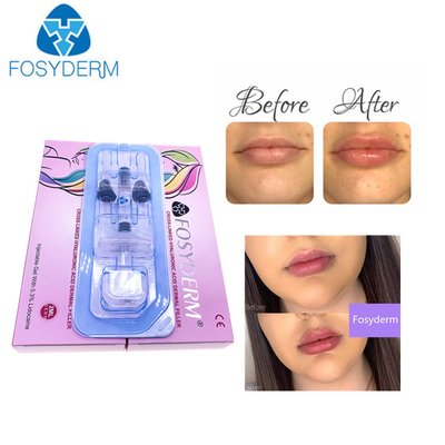 CE Sertifikası 1ml Derin Hyaluronik Asit Derm HA Dudaklar İçin Dermal Dolgu