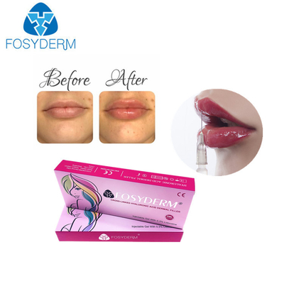 Kadınlar İçin 1ml hyaluronik asit dudak dolgusu Derm Dudak Geliştirme Enjeksiyonu
