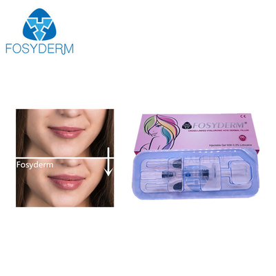 2 ml dolgu Hyaluronik Asit Dermal Dolgu Yüz Burn Dudak Genişletme 24mg/ml