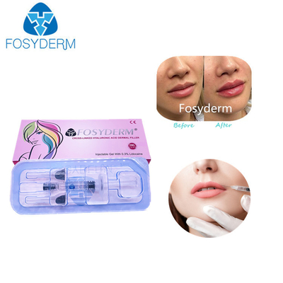 2 Ml Asit Hyaluronik Çapraz Bağlı Dermal Dolgu Dudak Dolgu Enjeksiyonları