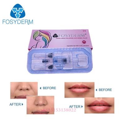 Dudaklar İçin Yüz Kırışıklığı Ha Jel Dermal Dolgu Enjekte Edilebilir Hyaluronik Asit Dolgu