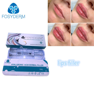 Dolgu Yüz Enjeksiyonu Fosyderm Fosyderm Hyaluronik Asit Dudak Dolguları 1ml